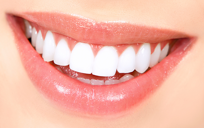 Teeth Whitening Fort Myers FL- Teeth Bleaching