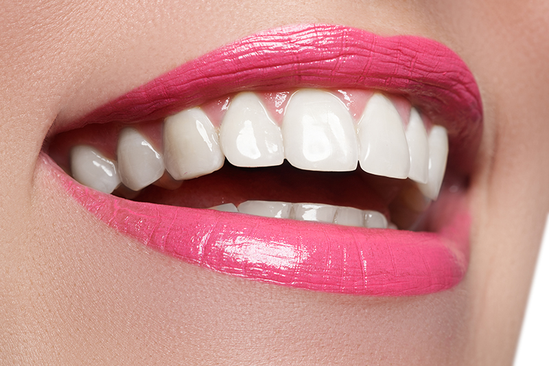 woman with porcelain veneers